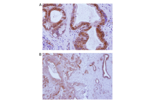 Immunohistochemistry on pancreatic adenocarcinoma (PDAC) FFPE tissue sections. The primary TMEM173 antibody ABIN3043423 was used 1:500 diluted in 5% normal Goat serum in PBS with a biotin-donkey-anti-rabbit IgG (H+L) secondary antibody. A. IHC staining of PDAC tissue from patient #1 at 400x magnification. B. IHC staining of PDAC tissue from patient #2 at 200x magnification.
