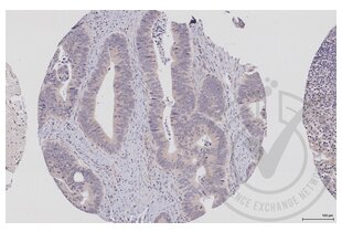 Figure 2: Human colon tissue stained with anti-EIF4E (brown) and counterstained with hematoxylin. 
