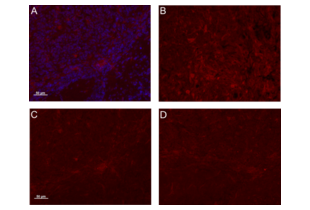 Immunohistochemistry (Formalin-fixed Paraffin-embedded Sections) validation image for anti-Osteoactivin (GPNMB) (AA 81-180) antibody (ABIN749093)