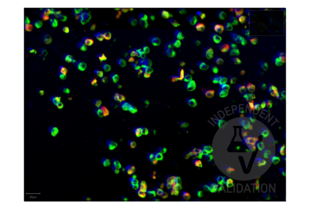 Immunofluorescence of SARS-CoV-2 infection in FFPE cell pellets from in vitro cultured human lung cells infected with SARS-CoV-2. Costaining with anti-SARS-CoV-2 Spike S1 antibody RBD antibody ABIN6952546 (green) and anti-SARS-CoV-2 Nucleocapsid Protein antibody ABIN6952544 (red).