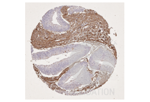 IHC staining of colorectal carcinoma with collagen type I antibody ABIN5596819 diluted 1:15 shows dense fibrillar collagen I deposits in the stroma. Cancer cells are collagen I negative.