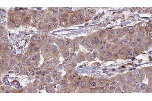 ABIN6276297 at 1/100 staining Human liver cancer tissue by IHC-P. (BVES 抗体  (Internal Region))