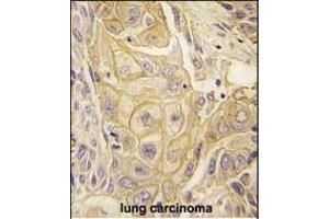 Formalin-fixed and paraffin-embedded human lung carcinoma tissue reacted with EphB2 antibody (ABIN391921 and ABIN2841731) , which was peroxidase-conjugated to the secondary antibody, followed by DAB staining. (EPH Receptor B2 抗体)