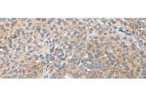 Immunohistochemistry of paraffin-embedded Human liver cancer tissue using CBR3 Polyclonal Antibody at dilution of 1:35(x200) (CBR3 抗体)