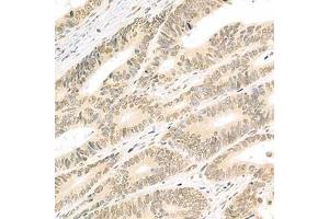 Immunohistochemistry analysis of paraffin-embedded human colon cancer using Isx (ABIN7074369) at dilution of 1: 2000 (ISX 抗体)