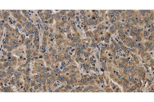 Immunohistochemistry of paraffin-embedded Human liver cancer tissue using KCNMB2 Polyclonal Antibody at dilution 1:40