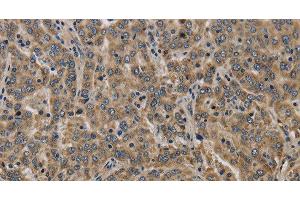 Immunohistochemistry of paraffin-embedded Human liver cancer tissue using KCNMB2 Polyclonal Antibody at dilution 1:40 (KCNMB2 抗体)