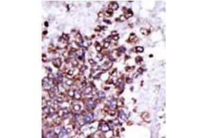 Formalin-fixed and paraffin-embedded human cancer tissue (hepatocarcinoma) reacted with the primary antibody, which was peroxidase-conjugated to the secondary antibody, followed by DAB staining. (CAMK1 抗体  (C-Term))