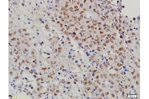 Formalin-fixed and paraffin embedded mouse cervical cancer labeled with Anti-MAT-1 Polyclonal Antibody, Unconjugated (ABIN686182) followed by conjugation to the secondary antibody and DAB staining (MTA1 抗体  (AA 601-715))