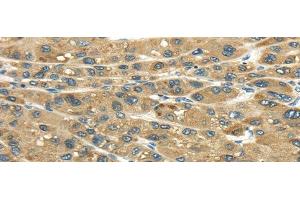 Immunohistochemistry of paraffin-embedded Human liver cancer tissue using UGT2B4 Polyclonal Antibody at dilution 1:45 (UGT2B4 抗体)