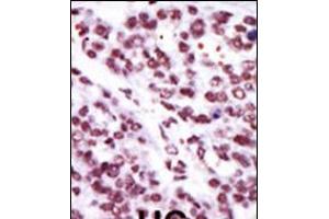 Formalin-fixed and paraffin-embedded human cancer tissue reacted with the primary antibody, which was peroxidase-conjugated to the secondary antibody, followed by AEC staining. (PKC epsilon 抗体  (N-Term))