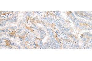 Immunohistochemistry of paraffin-embedded Human thyroid cancer tissue using TMEM248 Polyclonal Antibody at dilution of 1:25(x200) (C7orf42 抗体)
