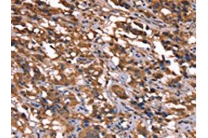 The image on the left is immunohistochemistry of paraffin-embedded Human thyroid cancer tissue using ABIN7190865(GREB1 Antibody) at dilution 1/40, on the right is treated with synthetic peptide. (GREB1 抗体)