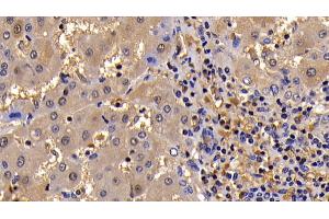 Detection of Bcl2L in Human Liver Cirrhosis Tissue using Polyclonal Antibody to B-Cell CLL/Lymphoma 2 Like Protein (Bcl2L) (BCL2L1 抗体  (AA 2-212))