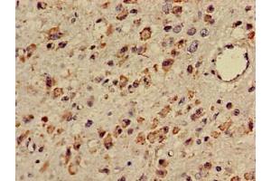 Immunohistochemistry of paraffin-embedded human glioma using ABIN7171919 at dilution of 1:100 (TTC27 抗体  (AA 590-817))