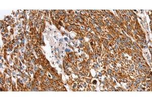 Immunohistochemistry of paraffin-embedded Human lung cancer using SSBP1 Polyclonal Antibody at dilution of 1:30 (SSBP1 抗体)