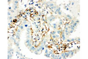 Anti-Transglutaminase 2 antibody, IHC(P) IHC(P): Human Lung Cancer Tissue (Transglutaminase 2 抗体  (C-Term))