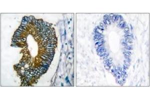 Immunohistochemistry analysis of paraffin-embedded human lung carcinoma tissue, using Keratin 18 Antibody. (Cytokeratin 18 抗体  (AA 381-430))