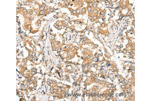 Immunohistochemistry of Human lung cancer using SIRT4 Polyclonal Antibody at dilution of 1:35 (SIRT4 抗体)