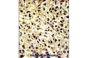 Formalin-fixed and paraffin-embedded human hepatocarcinoma with DCL-1 Antibody (Center), which was peroxidase-conjugated to the secondary antibody, followed by DAB staining. (DCL1 抗体  (AA 143-170))