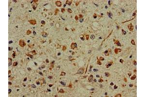 Immunohistochemistry of paraffin-embedded human glioma using ABIN7156227 at dilution of 1:100 (PFAS 抗体  (AA 1064-1302))