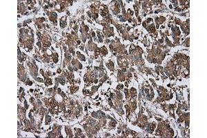 Immunohistochemical staining of paraffin-embedded Carcinoma of liver tissue using anti-BTK mouse monoclonal antibody. (BTK 抗体)