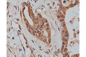 ABIN6273320 at 1/200 staining human colon cancer tissue sections by IHC-P. (SLC25A46 抗体  (N-Term))