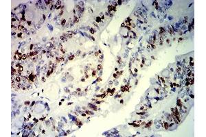 Immunohistochemical analysis of paraffin-embedded rectum cancer tissues using MKI67 mouse mAb with DAB staining. (Ki-67 抗体  (AA 1160-1493))