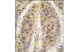 Formalin-fixed and paraffin-embedded human hepatocarcinoma tissue reacted with ADK antibody (C-term), which was peroxidase-conjugated to the secondary antibody, followed by DAB staining. (ADK 抗体  (C-Term))