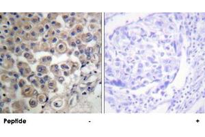 Immunohistochemistry analysis of paraffin-embedded human breast carcinoma tissue using PLCB3 polyclonal antibody . (PLCB3 抗体)