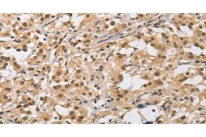 Immunohistochemistry of paraffin-embedded Human thyroid cancer tissue using AMZ2 Polyclonal Antibody at dilution 1:40 (AMZ2 抗体)