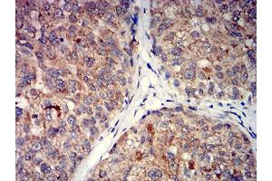 Immunohistochemical analysis of paraffin-embedded bladder cancer tissues using GRM5 mouse mAb with DAB staining. (Metabotropic Glutamate Receptor 5 抗体  (AA 458-580))