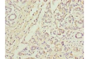 Immunohistochemistry of paraffin-embedded human pancreatic cancer using ABIN7144074 at dilution of 1:100