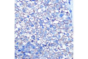 Immunohistochemistry of paraffin-embedded human liver cancer using CD13/ANPEP Rabbit mAb (ABIN7265525) at dilution of 1:100 (40x lens). (CD13 抗体)
