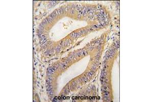 Formalin-fixed and paraffin-embedded human colon carcinoma tissue reacted with PHB2 Antibody , which was peroxidase-conjugated to the secondary antibody, followed by DAB staining. (Prohibitin 2 抗体  (N-Term))