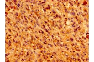 Immunohistochemistry of paraffin-embedded human melanoma using ABIN7156987 at dilution of 1:100 (IFT46 抗体  (AA 1-304))