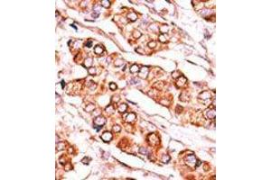 Formalin-fixed and paraffin-embedded human cancer tissue reacted with the primary antibody, which was peroxidase-conjugated to the secondary antibody, followed by DAB staining. (PDXK 抗体  (C-Term))