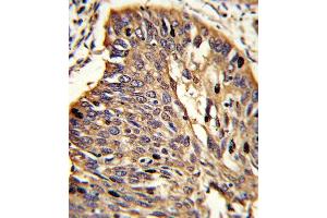 Formalin-fixed and paraffin-embedded human lung carcinoma reacted with MyD88 Antibody (Center), which was peroxidase-conjugated to the secondary antibody, followed by DAB staining. (MYD88 抗体  (AA 136-164))