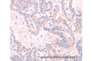 Immunohistochemistry of Human thyroid cancer using INA Polyclonal Antibody at dilution of 1:25 (INA 抗体)
