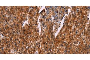 Immunohistochemistry of paraffin-embedded Human gastric cancer tissue using HSPB6 Polyclonal Antibody at dilution 1:30 (HSPB6 抗体)