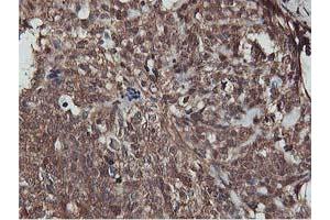 Immunohistochemical staining of paraffin-embedded Adenocarcinoma of Human breast tissue using anti-AKT1 mouse monoclonal antibody. (AKT1 抗体)