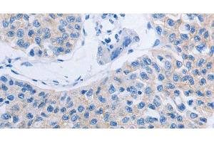Immunohistochemistry of paraffin-embedded Human lung cancer tissue using HOXA6 Polyclonal Antibody at dilution 1:60 (HOXA6 抗体)