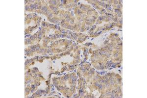 Immunohistochemistry of paraffin-embedded human thyroid cancer using XRCC2 antibody at dilution of 1:200 (x400 lens) (XRCC2 抗体)