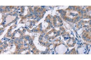 Immunohistochemistry of paraffin-embedded Human thyroid cancer using KCNQ5 Polyclonal Antibody at dilution of 1:30 (KCNQ5 抗体)