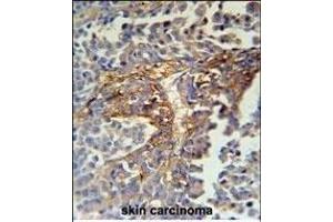 ARMC5 Antibody (C-term) (ABIN651593 and ABIN2840314) immunohistochemistry analysis in formalin fixed and paraffin embedded human skin carcinoma followed by peroxidase conjugation of the secondary antibody and DAB staining. (ARMC5 抗体  (C-Term))
