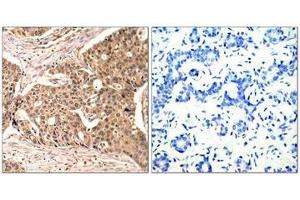 Immunohistochemical analysis of paraffin-embedded human breast carcinoma tissue using Paxillin(Phospho-Tyr118) Antibody(left) or the same antibody preincubated with blocking peptide(right).