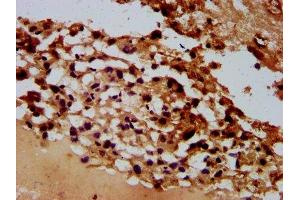 IHC image of ABIN7167931 diluted at 1:600 and staining in paraffin-embedded human melanoma performed on a Leica BondTM system. (ARHGAP15 抗体  (AA 1-154))