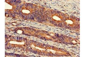 Immunohistochemistry of paraffin-embedded human colon cancer using ABIN7152309 at dilution of 1:100 (EXT2 抗体  (AA 180-267))