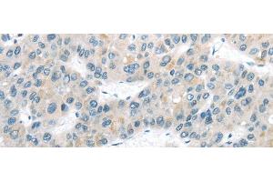 Immunohistochemistry of paraffin-embedded Human liver cancer tissue using VLDLR Polyclonal Antibody at dilution 1:40 (VLDLR 抗体)