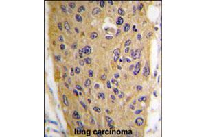 Formalin-fixed and paraffin-embedded human lung carcinoma tissue reacted with WIF1 polyclonal antibody  , which was peroxidase-conjugated to the secondary antibody, followed by DAB staining. (WIF1 抗体  (AA 350-379))